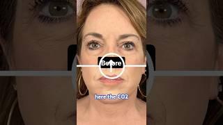 Laser Skin Resurfacing Removed 20 Years!  #CO2Laser #Rejuvenation #DeepPlaneFaceLift