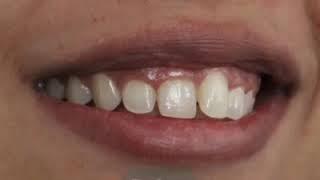 Smile Makeover for an interesting case of overlapped teeth and gummy smile| Best Cosmetic Dentist