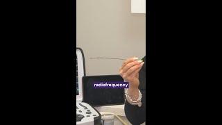 What's Radiofrequency Ablation for vein treatment?
