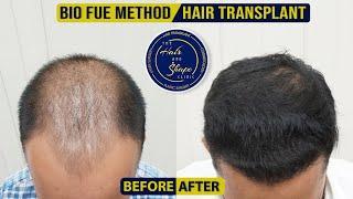 Best Hair Transplant Surgery In Mumbai ||The Hair and Shape Clinic ||Bio Fue Method Hair Transplant