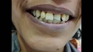 Porcelain Dental Veneers Before & After | Eledent Dental Hospitals | Best Dental Hospital In India