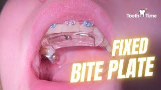 Deep Bite Braces - Fixed Bite Plate - ToothTime Family Dentistry