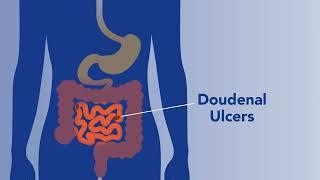 Common Digestive Ailments - Peptic Ulcer Disease