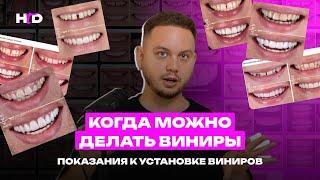 Что можно сделать с помощью виниров? Показания | PROвиниры Прокопович Виктор