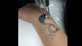 Laser Tattoo Removal Forearm at Skin Deep Laser Services Burke, Virginia