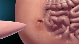 Sleeve Gastrectomy (Gastric sleeve)