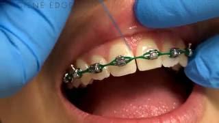 Flossing Braces With a Threader