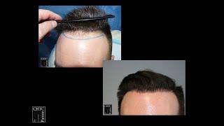 Before and After Photos of FUE Hair Transplant with 2,500 Grafts with PANINE, MD in Chicago, IL