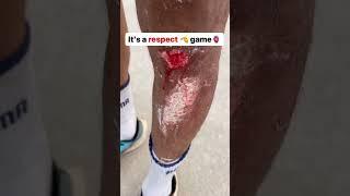 Skating Race Accident  #skate #skating #youtube #youtubeshorts #shortsvideo #sport #india