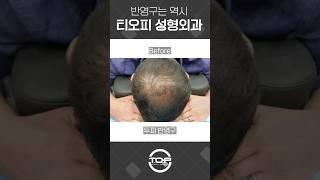 반영구화장 전후 #반영구화장 #반영구문신 #두피문신 #두피반영구 #두피문신전문 #두피문신잘하는곳 #두피커버링 #shorts