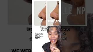 Nonsurgical nose job, nose filler, black girl nose job, how to fix nose tip droop, ginillenp