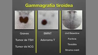 Tiroides: Hipertiroidismo