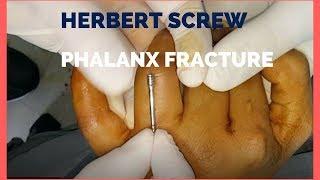 Phalanges - Herbert Screw