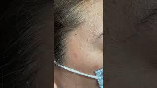 Come along and see Rita Balyan, PA-C from Skin & Beauty Center remove a cherry angioma