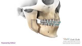 BSSO Mandibular Advancement