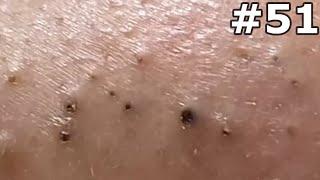 " Satisfying Pimple Popping Extravaganza! Watch the Most Satisfying Pops Ever!" #51