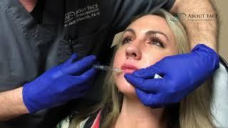 Juvederm Ultra Lip Filler Treatment Video