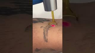 Tattoo removal in London and Birmingham #tattooremoval #lasertattooremoval #picolaser #picosecond