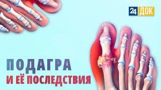 Покажем и расскажем, как вылечить подагру. МЕДСОВЕТ