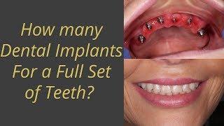 How many implants are needed to replace a full set of teeth?