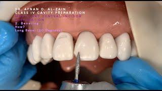 Class IV preparation and beveling – Maxillary central incisor (#21) - Arabic عربي