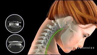 Artificial Disc for Cervical Disc Replacement | Bumrungrad