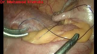 Dr. Mohamed Shehata, Laparoscopic Appendectomy, Tanta University, Egypt