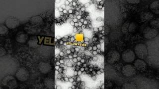 what the signs of yellow fever? #yellowfever #symptoms