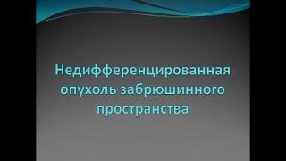 Недифференцированная опухоль забрюшинного пространства с метастазами в печень и лимфоузлы