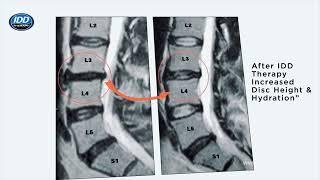 Your visit   IDD Therapy Advanced Nonsurgical Spinal Decompression Treatment