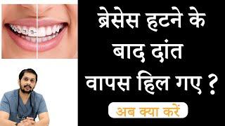 Relapse after braces | ब्रेसेस हटने के बाद दांत हिलने लगे | Best braces treatment in Indore