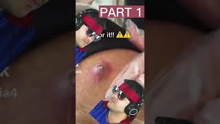 pimple popping videos blackheads,pimple popping tiktok,PIMPLE POPS,pimple popping ear blackheads