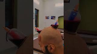 Best treatment for hair loss# Alopecia#Wet cupping # Hijama therapy