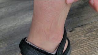 Socks leaving indents on ankles