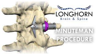 Longhorn Brain and Spine - The Minuteman Procedure