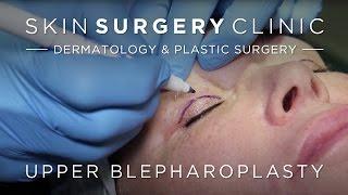 Upper Blepharoplasty Eyelid Surgery | Watch the Procedure