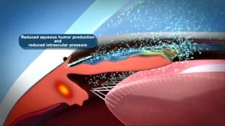 Eye Tech Care treatment principle videox