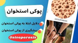 بیماری پوکی استخوان،دلایل ابتلا و راه های درمان پوکی استخوان (Osteoporosis)