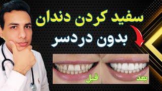 سفید کردن دندان در خانه | Teeth whitening at home