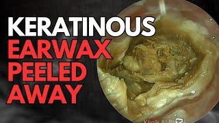 Keratinous Earwax Peeled Away