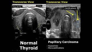 Thyroid Ultrasound Normal Vs Abnormal Image Appearances Comparison | Thyroid Pathologies USG