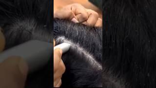 Dandruff Remove Home Remedy | Dandruff Hatane Ka Tarika #shorts #haircare #longhair #hairgrowth