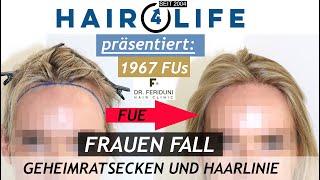 Haartransplantation Frauen | Geheimratsecken & Haarlinie | Vorher Nachher | Dr. Bijan Feriduni