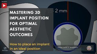 Mastering 3D Implant Position for Optimal Aesthetic Outcomes