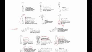 General principles of ortho trauma for PA students 1 - basics