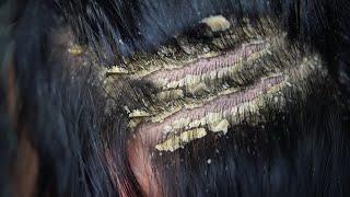 Dandruff scratching removal on head using black combing#449