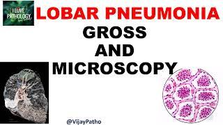 Lobar Pneumonia |  Pathology |  Gross and Microscopy  |   Illustration | Draw With Me!