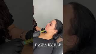 Lemon Bottle treatment in London at Faces By Bae