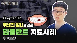 부러진 앞니 ▶ 임플란트 치료 사례 | 야간진료 【더365치과】 진료일지 #2