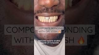 Composite bonding with Dr. Josh  #ruhdental